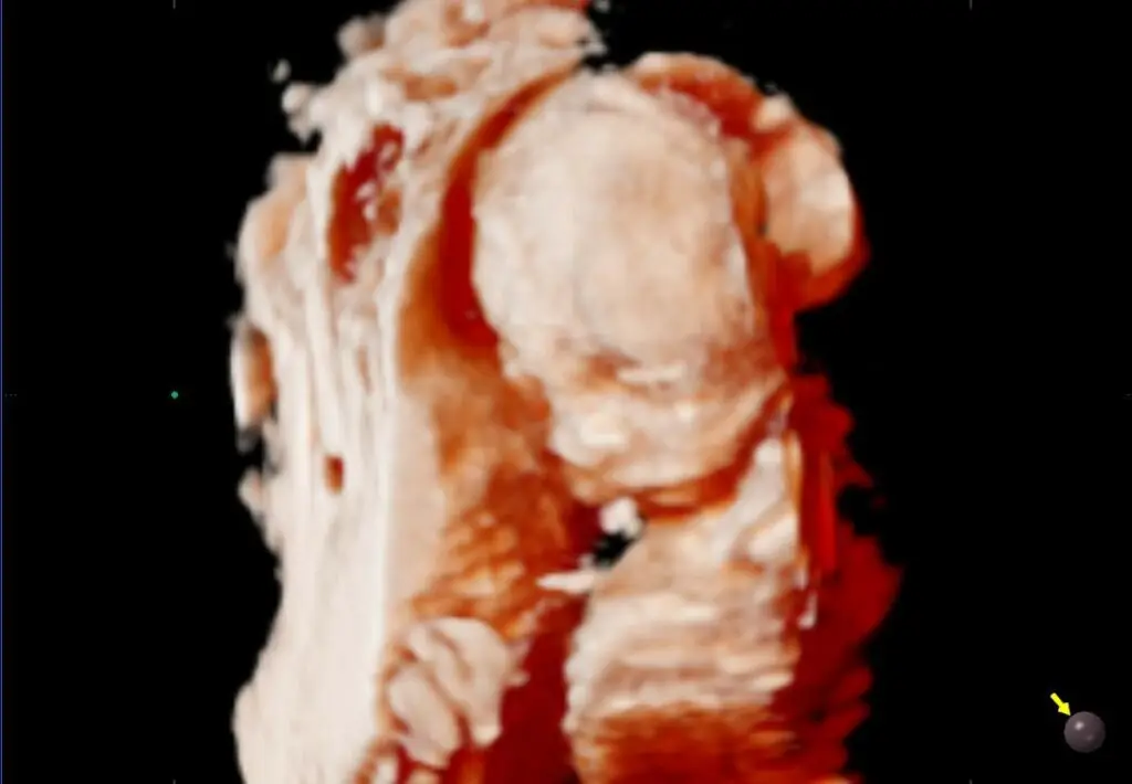 Echt overleden kindje 3D